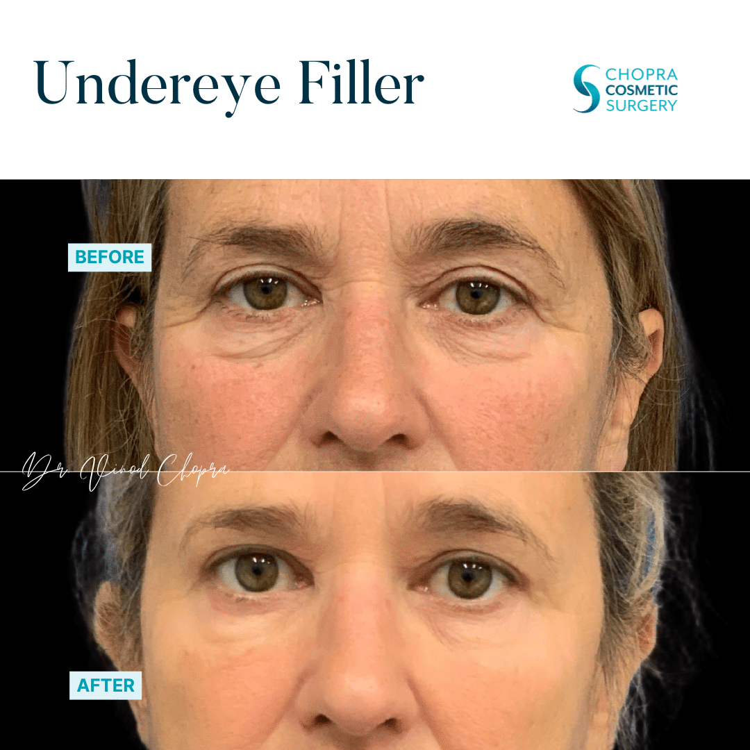 Dermal Filler Real Patient Results by Dr. Vinod Chopra in Washington, D.C. and Fairfax, VA