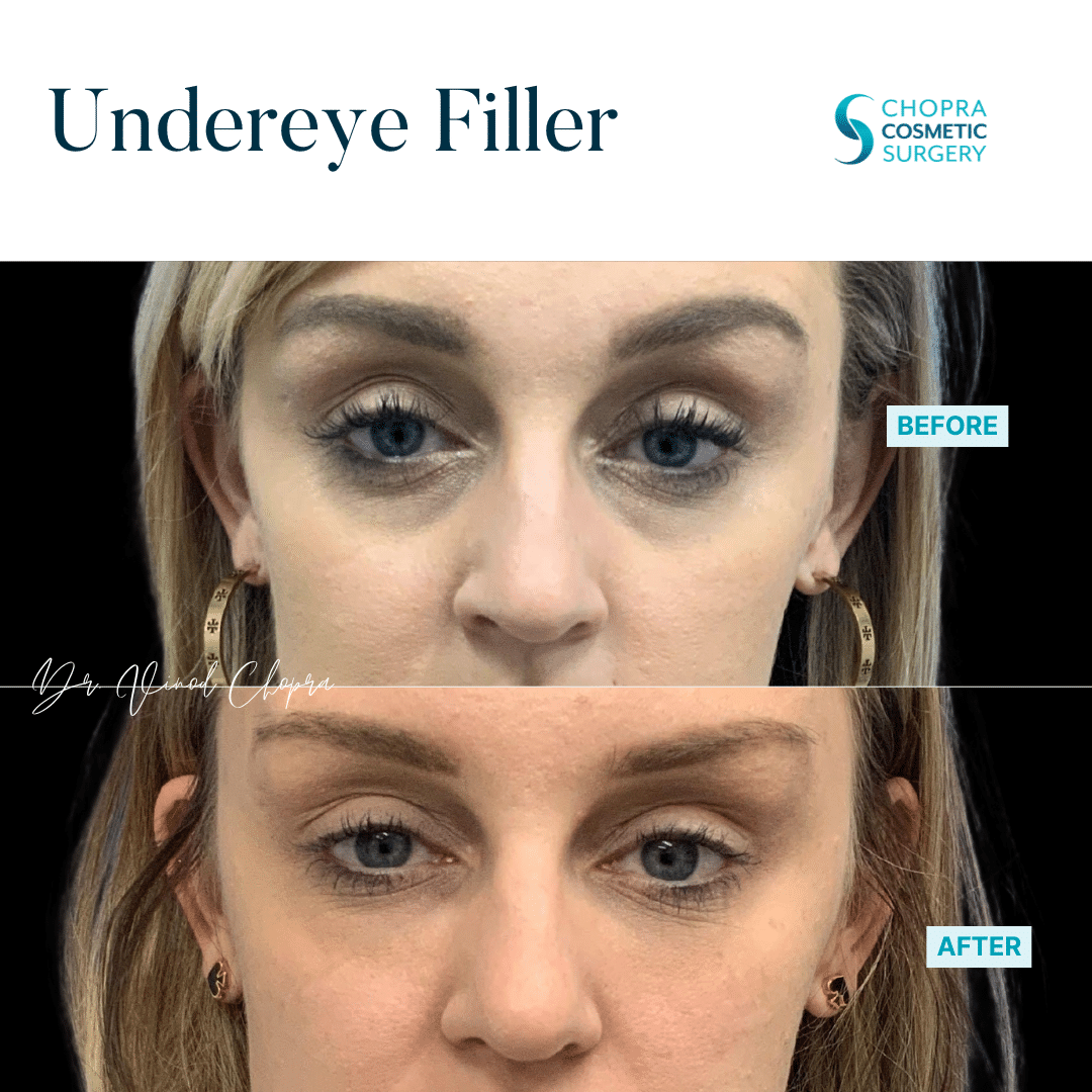Dermal Filler Real Patient Results by Dr. Vinod Chopra in Washington, D.C. and Fairfax, VA