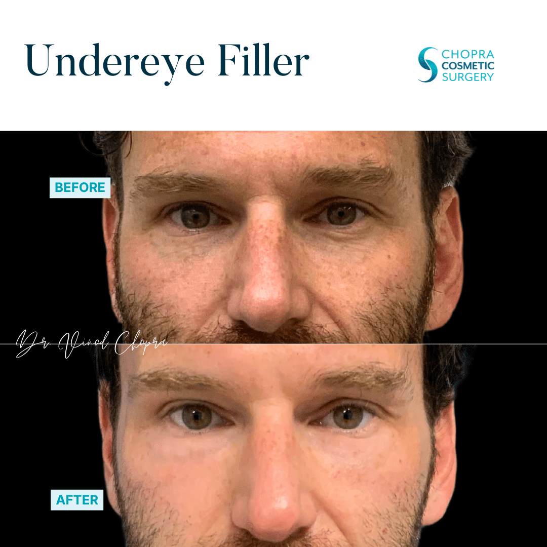Dermal Filler Real Patient Results by Dr. Vinod Chopra in Washington, D.C. and Fairfax, VA