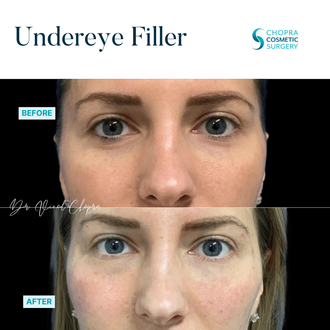 Dermal Filler Real Patient Results by Dr. Vinod Chopra in Washington, D.C. and Fairfax, VA