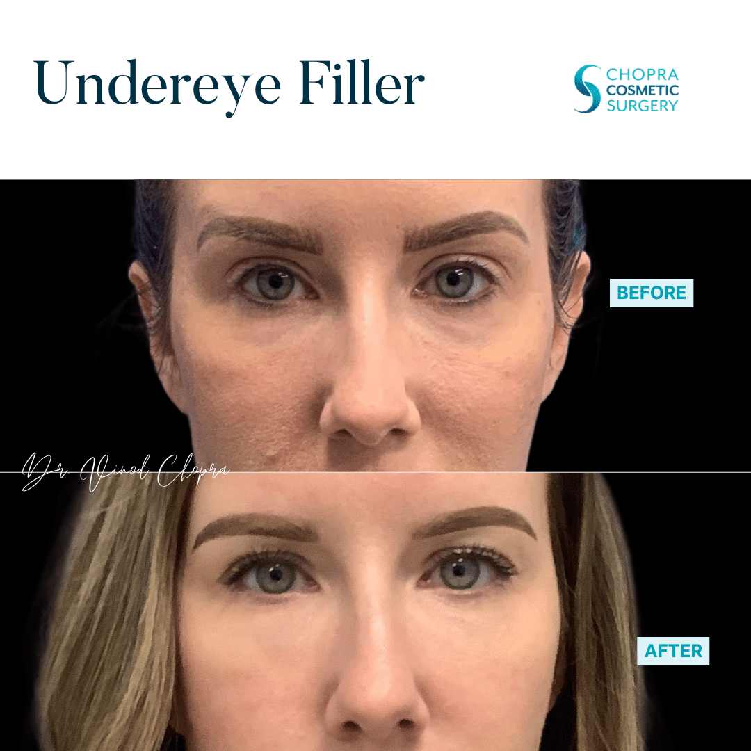 Dermal Filler Real Patient Results by Dr. Vinod Chopra in Washington, D.C. and Fairfax, VA