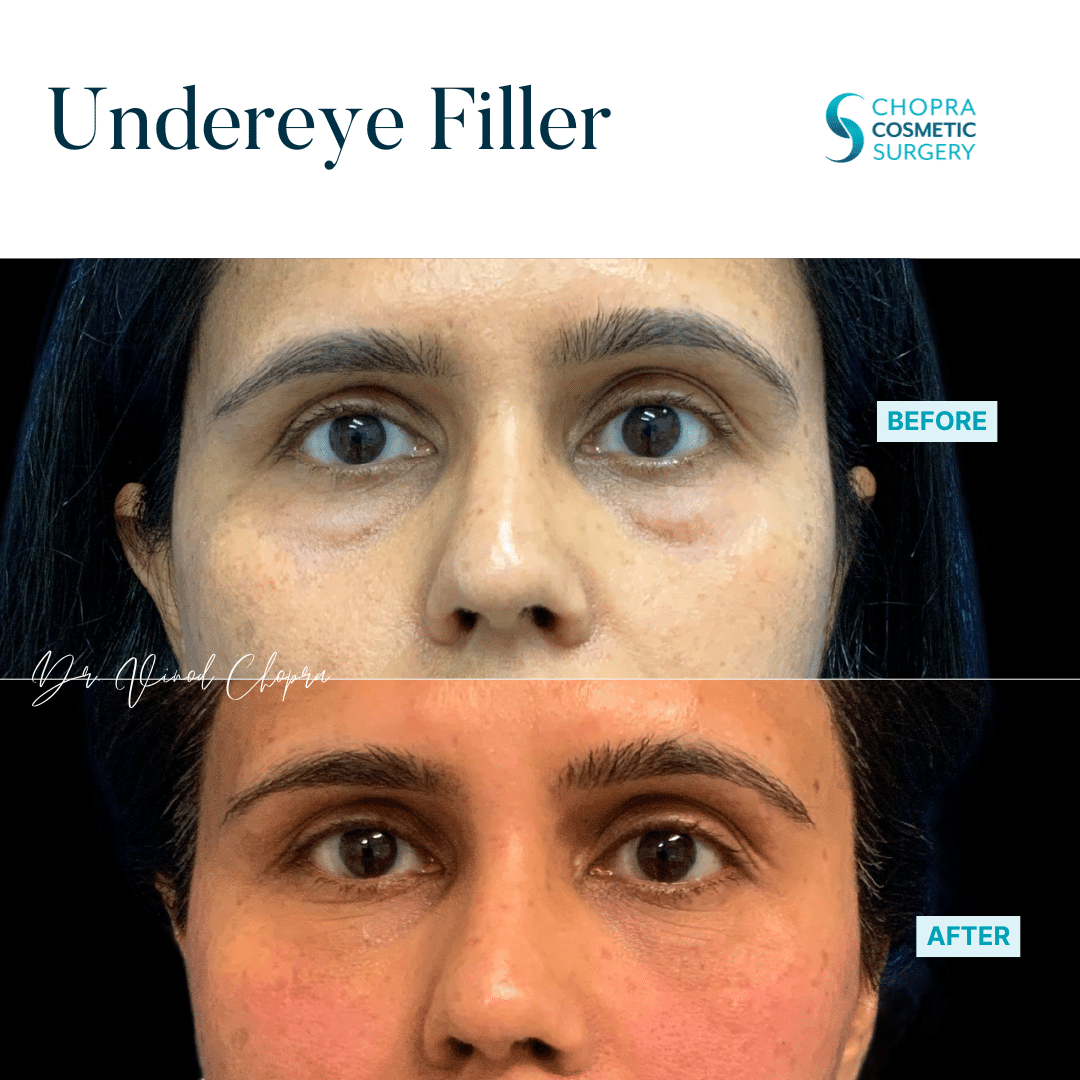 Dermal Filler Real Patient Results by Dr. Vinod Chopra in Washington, D.C. and Fairfax, VA