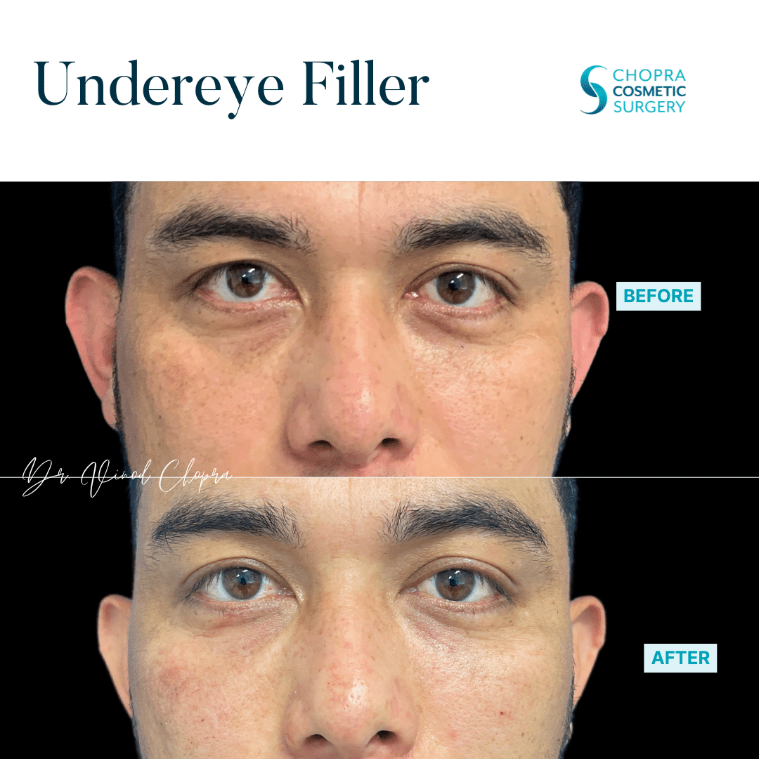 Dermal Filler Real Patient Results by Dr. Vinod Chopra in Washington, D.C. and Fairfax, VA