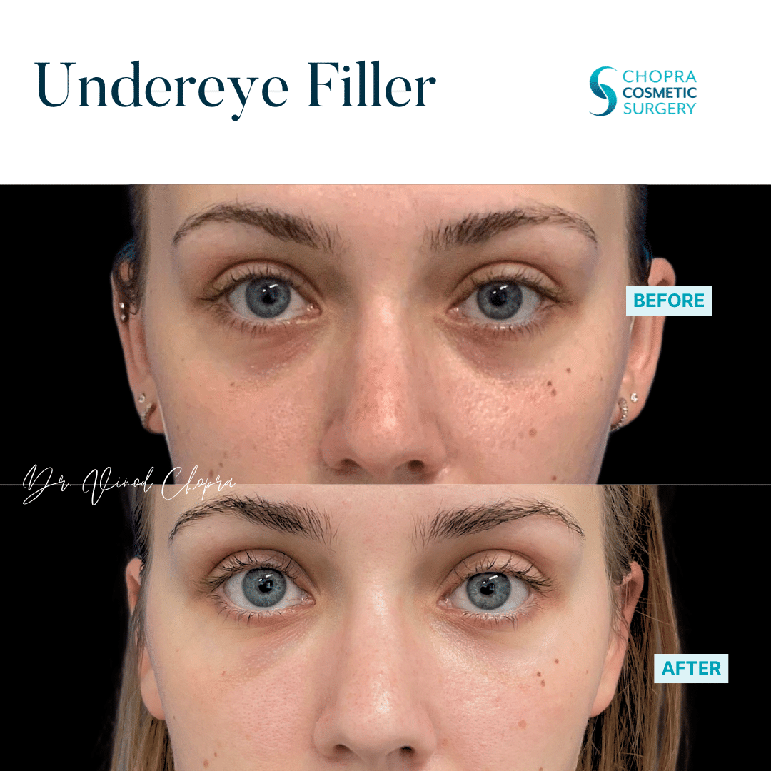 Dermal Filler Real Patient Results by Dr. Vinod Chopra in Washington, D.C. and Fairfax, VA