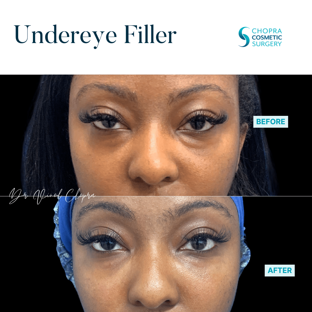 Dermal Filler Real Patient Results by Dr. Vinod Chopra in Washington, D.C. and Fairfax, VA