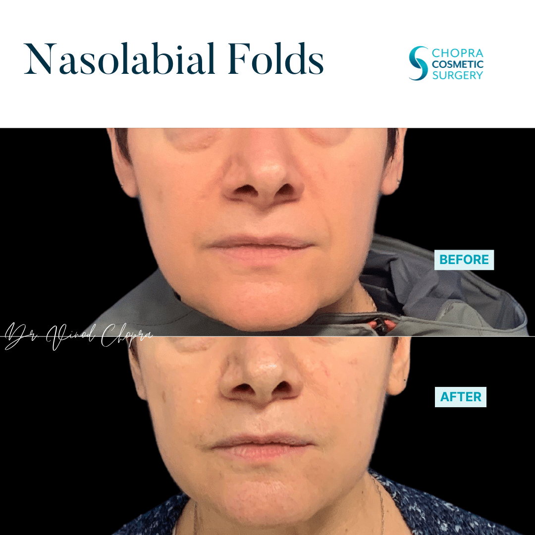 Dermal Filler Real Patient Results by Dr. Vinod Chopra in Washington, D.C. and Fairfax, VA