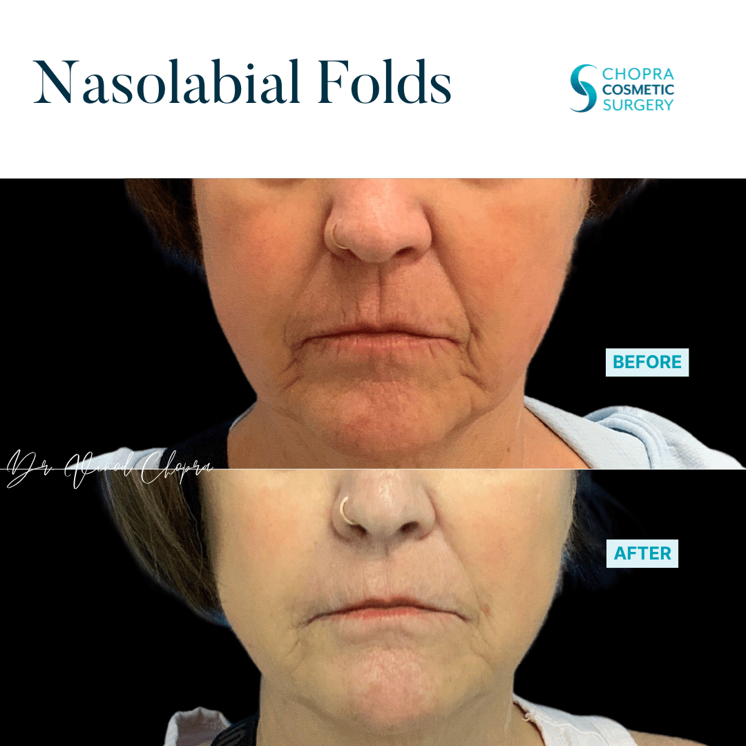 Dermal Filler Real Patient Results by Dr. Vinod Chopra in Washington, D.C. and Fairfax, VA