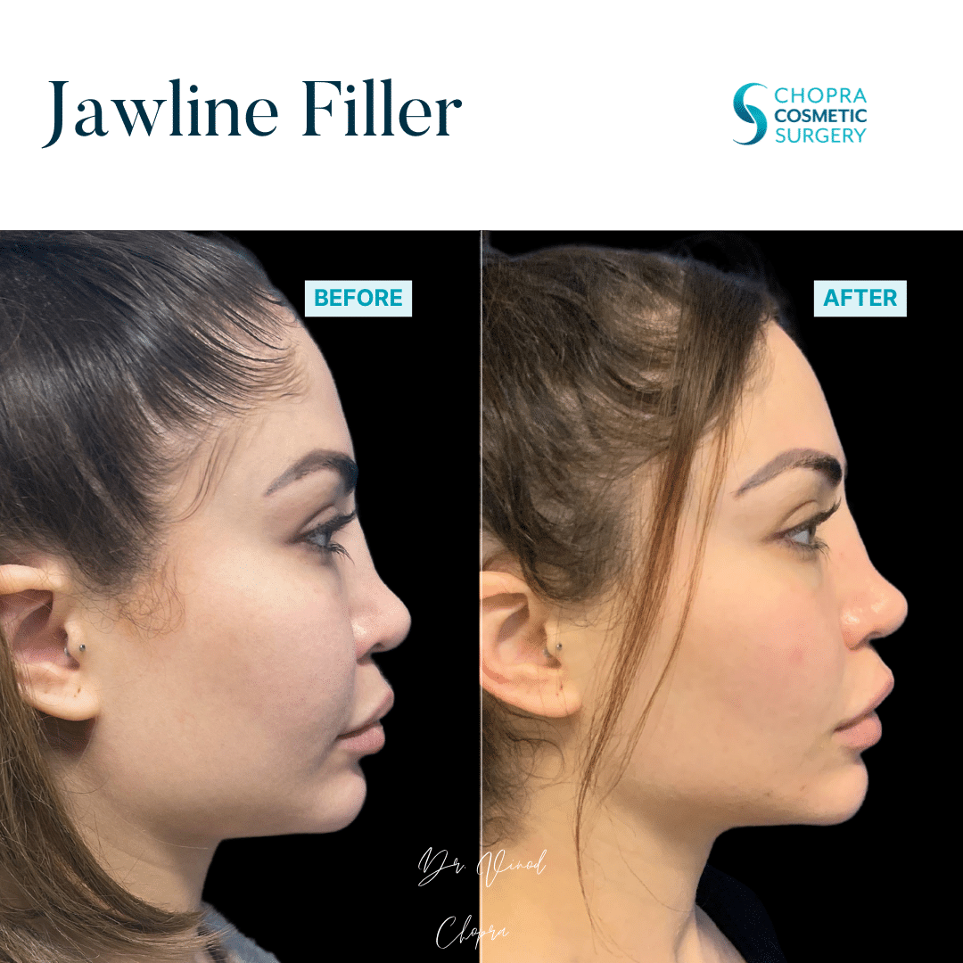 Dermal Filler Real Patient Results by Dr. Vinod Chopra in Washington, D.C. and Fairfax, VA