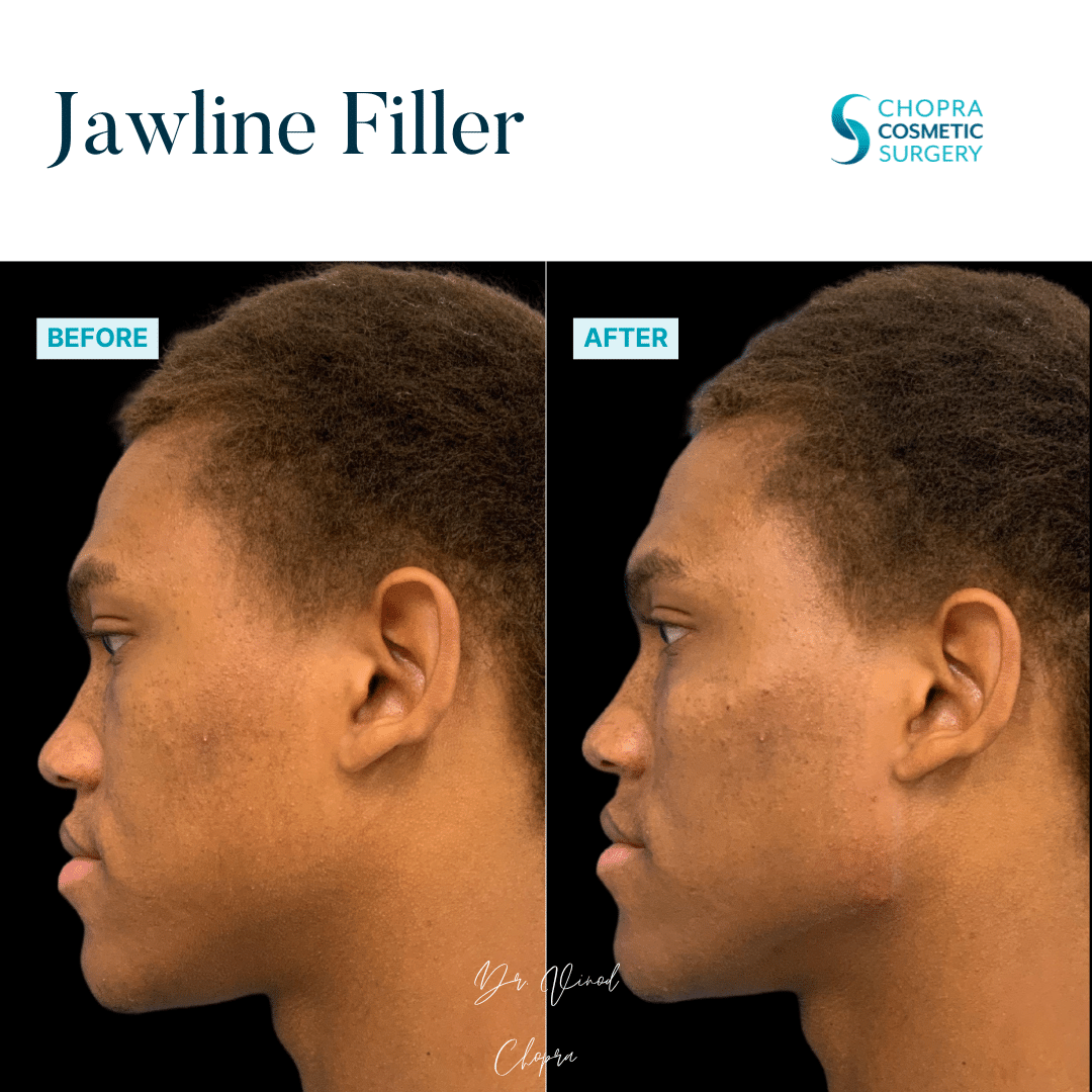 Dermal Filler Real Patient Results by Dr. Vinod Chopra in Washington, D.C. and Fairfax, VA