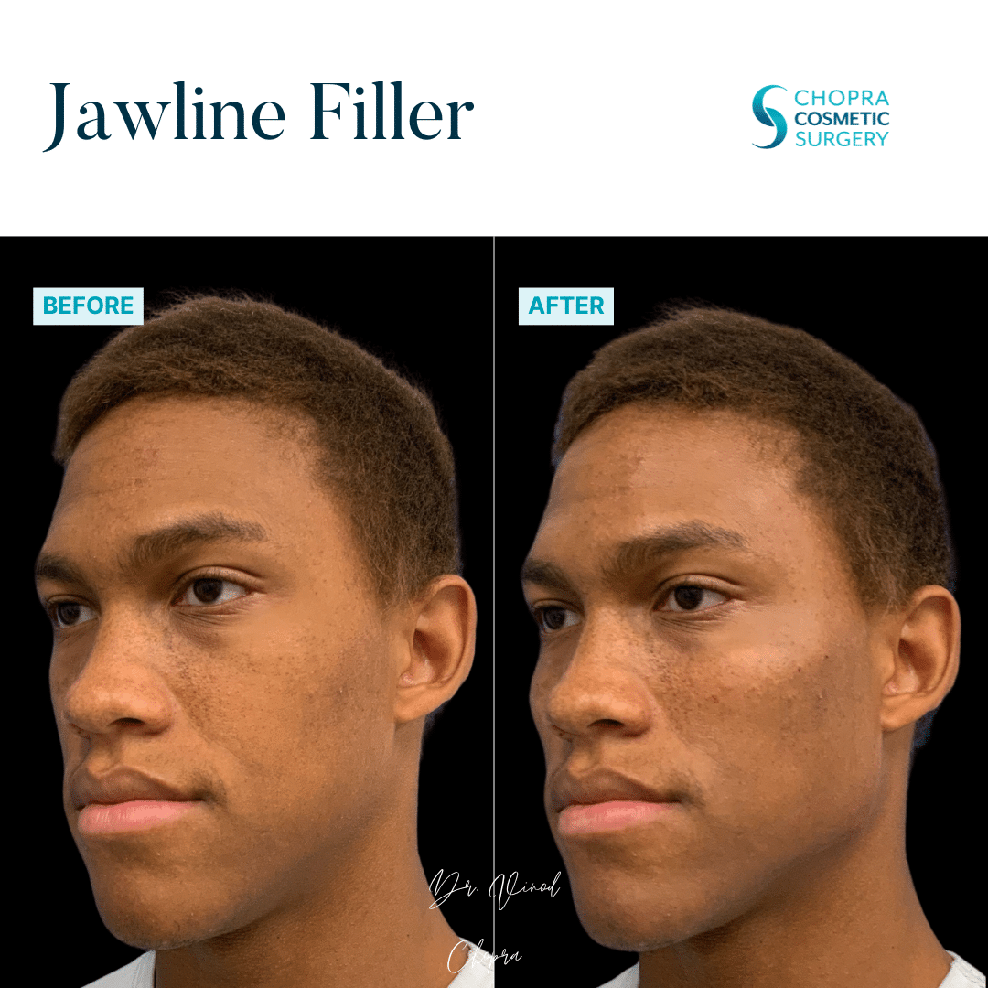 Dermal Filler Real Patient Results by Dr. Vinod Chopra in Washington, D.C. and Fairfax, VA