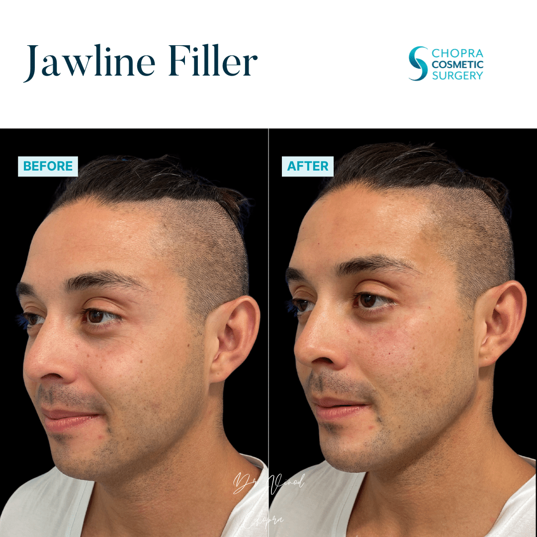 Dermal Filler Real Patient Results by Dr. Vinod Chopra in Washington, D.C. and Fairfax, VA