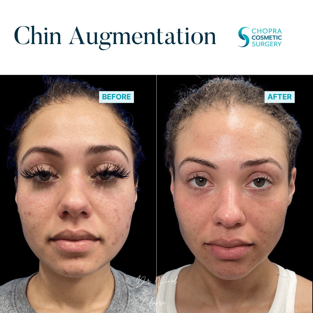 Dermal Filler Real Patient Results by Dr. Vinod Chopra in Washington, D.C. and Fairfax, VA