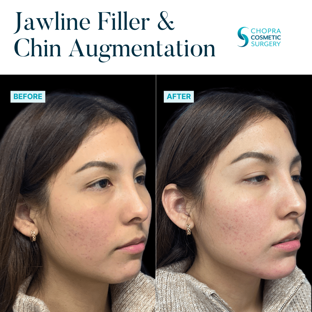 Dermal Filler Real Patient Results by Dr. Vinod Chopra in Washington, D.C. and Fairfax, VA