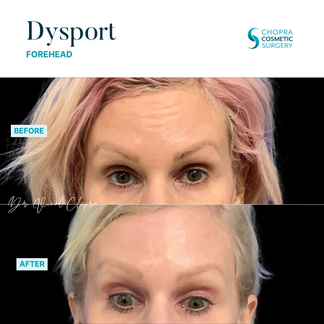 Neurotoxin Real Patient Results by Dr. Vinod Chopra in Washington, D.C. and Fairfax, VA