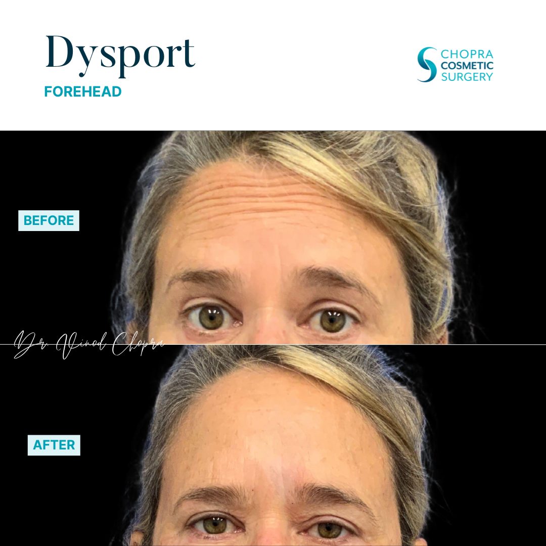 Neurotoxin Real Patient Results by Dr. Vinod Chopra in Washington, D.C. and Fairfax, VA