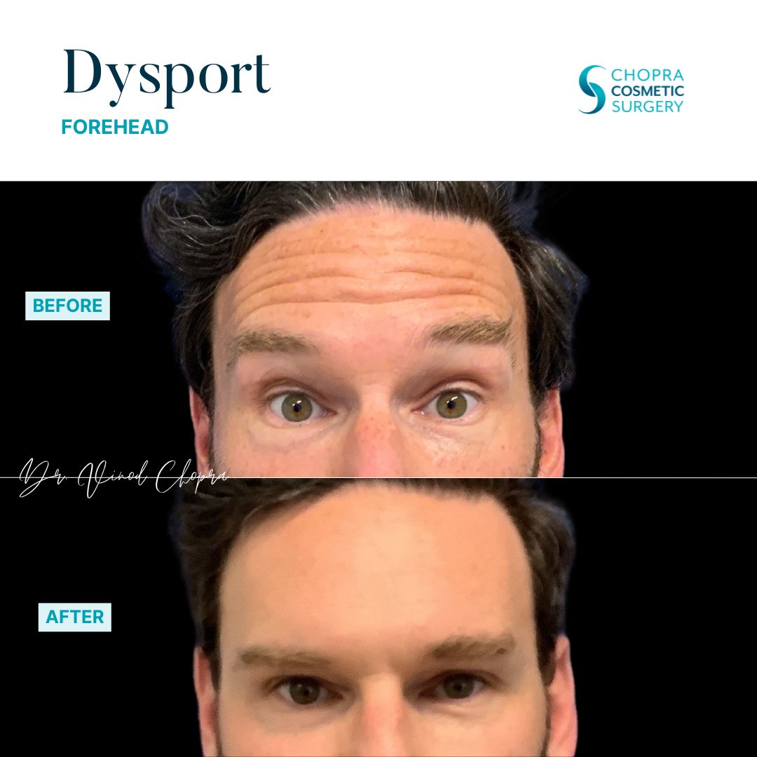 Neurotoxin Real Patient Results by Dr. Vinod Chopra in Washington, D.C. and Fairfax, VA
