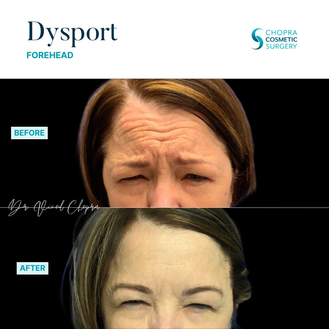 Neurotoxin Real Patient Results by Dr. Vinod Chopra in Washington, D.C. and Fairfax, VA