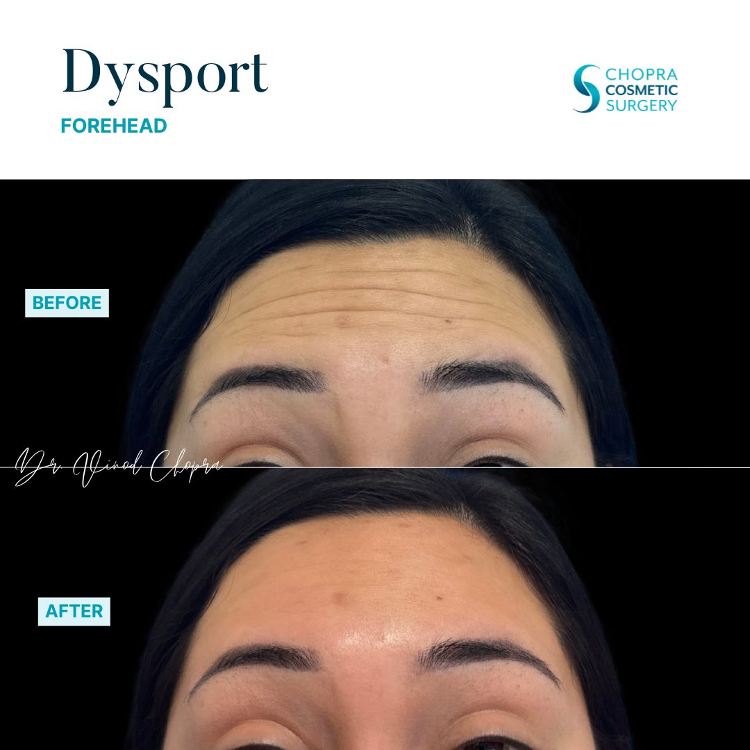 Neurotoxin Real Patient Results by Dr. Vinod Chopra in Washington, D.C. and Fairfax, VA