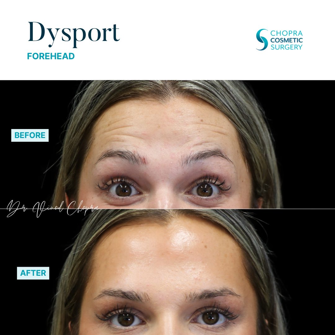 Neurotoxin Real Patient Results by Dr. Vinod Chopra in Washington, D.C. and Fairfax, VA