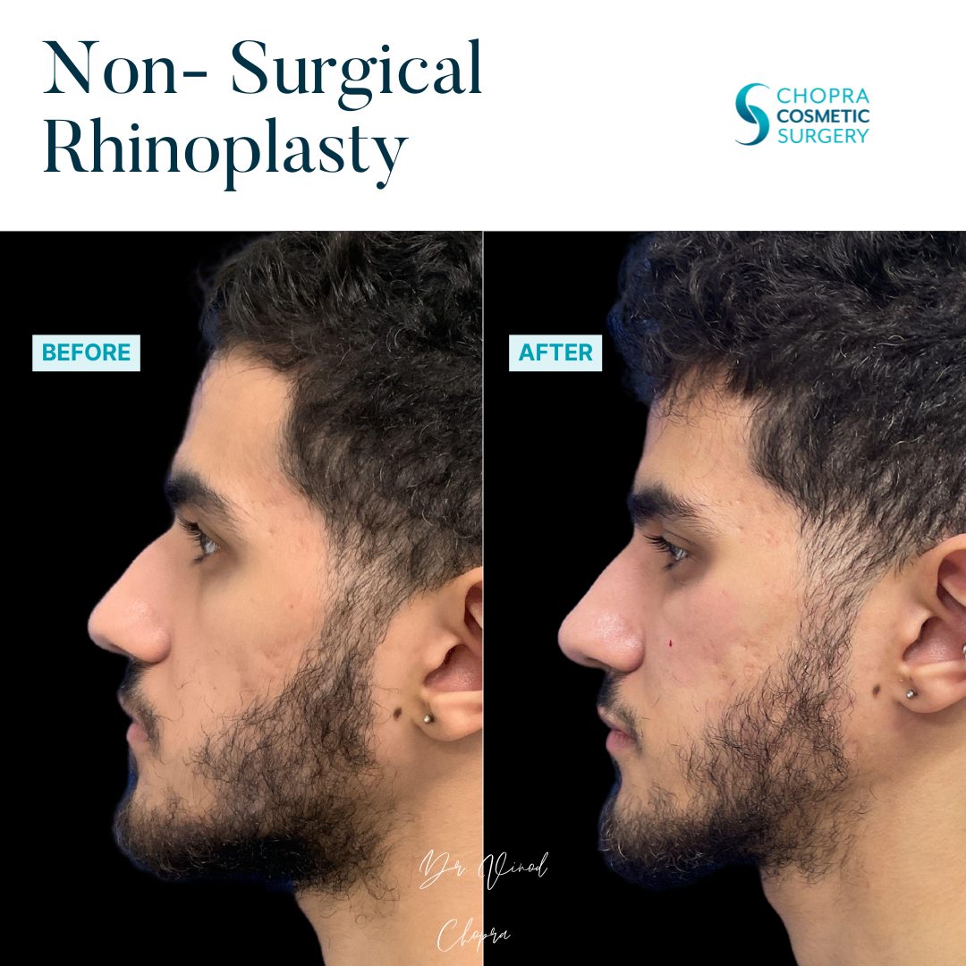 Non-Surgical Rhinoplasty Real Patient Results by Dr. Vinod Chopra in Washington, D.C. and Fairfax, VA