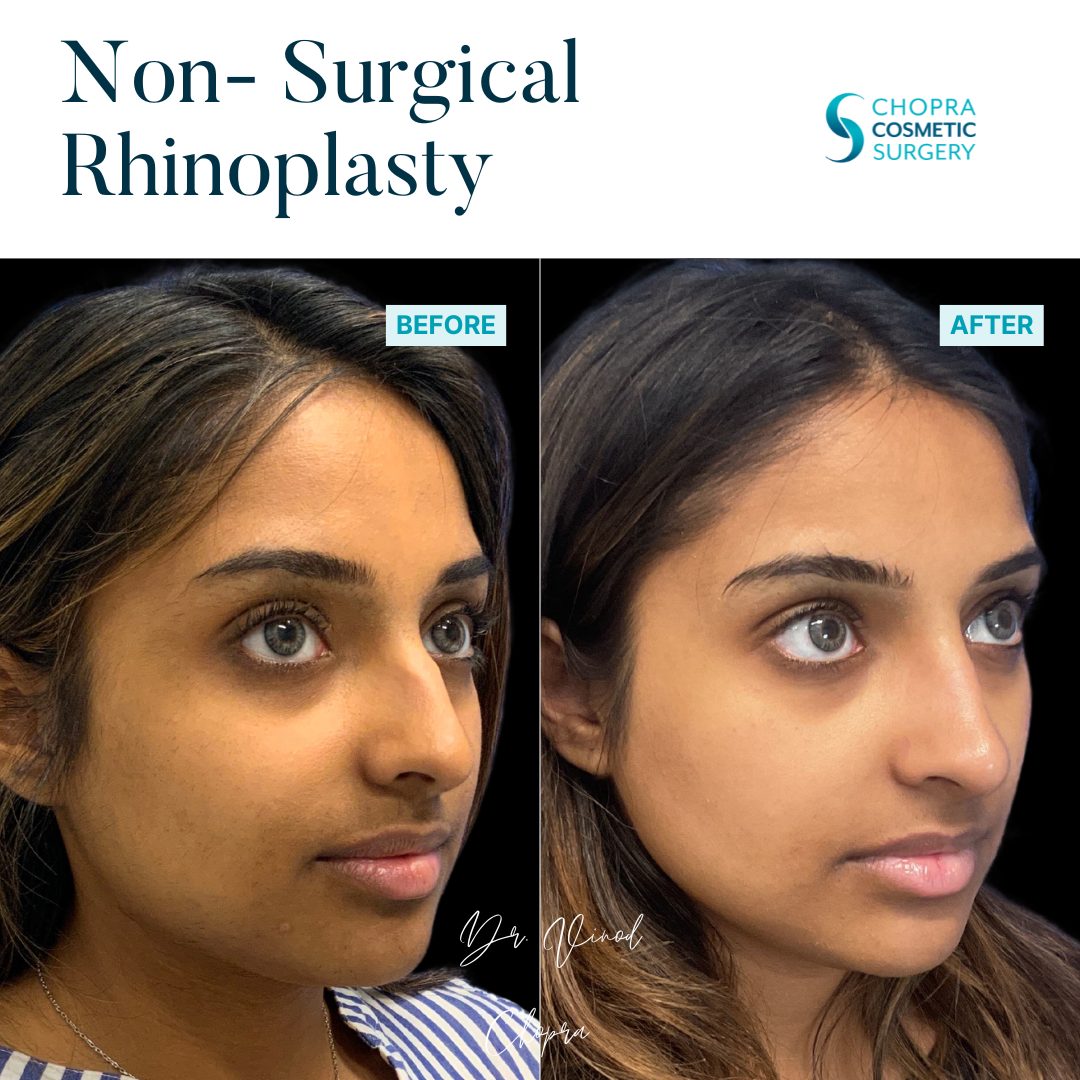 Non-Surgical Rhinoplasty Real Patient Results by Dr. Vinod Chopra in Washington, D.C. and Fairfax, VA