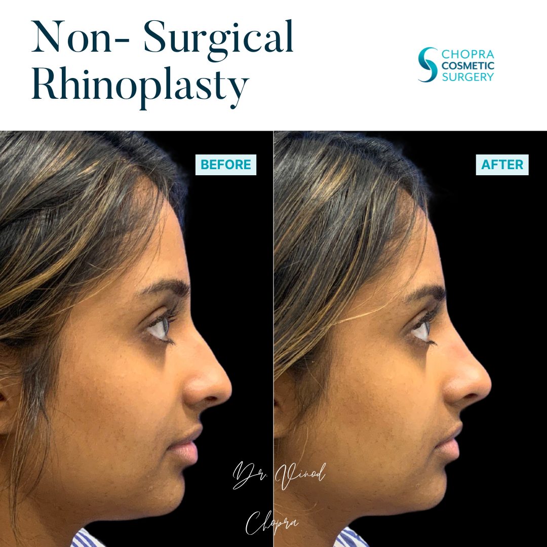 Non-Surgical Rhinoplasty Real Patient Results by Dr. Vinod Chopra in Washington, D.C. and Fairfax, VA