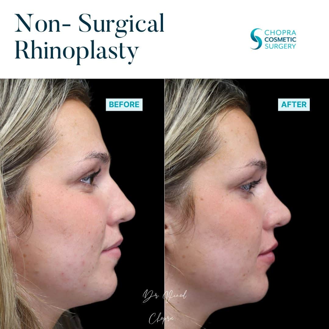 Non-Surgical Rhinoplasty Real Patient Results by Dr. Vinod Chopra in Washington, D.C. and Fairfax, VA
