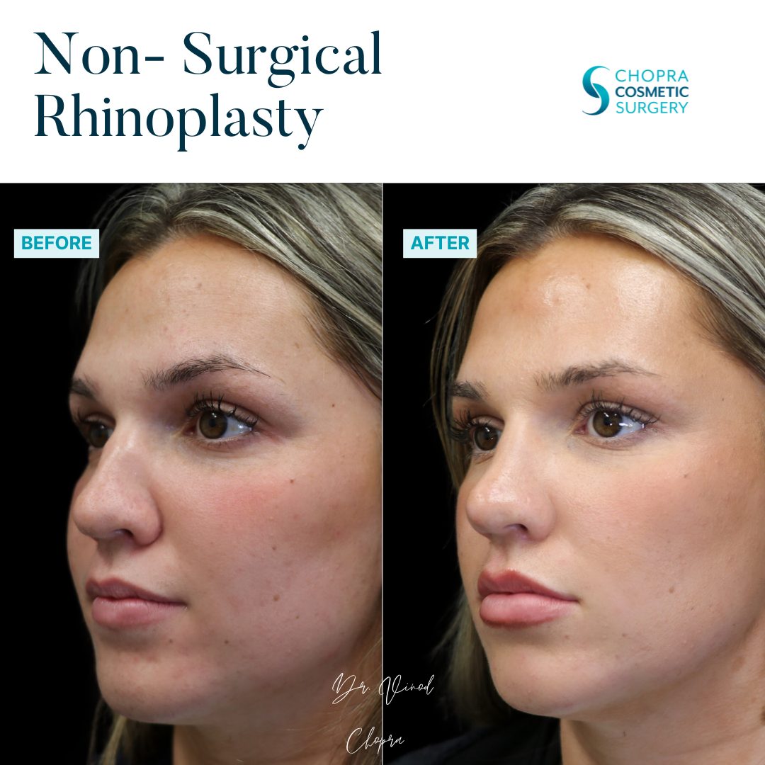Non-Surgical Rhinoplasty Real Patient Results by Dr. Vinod Chopra in Washington, D.C. and Fairfax, VA