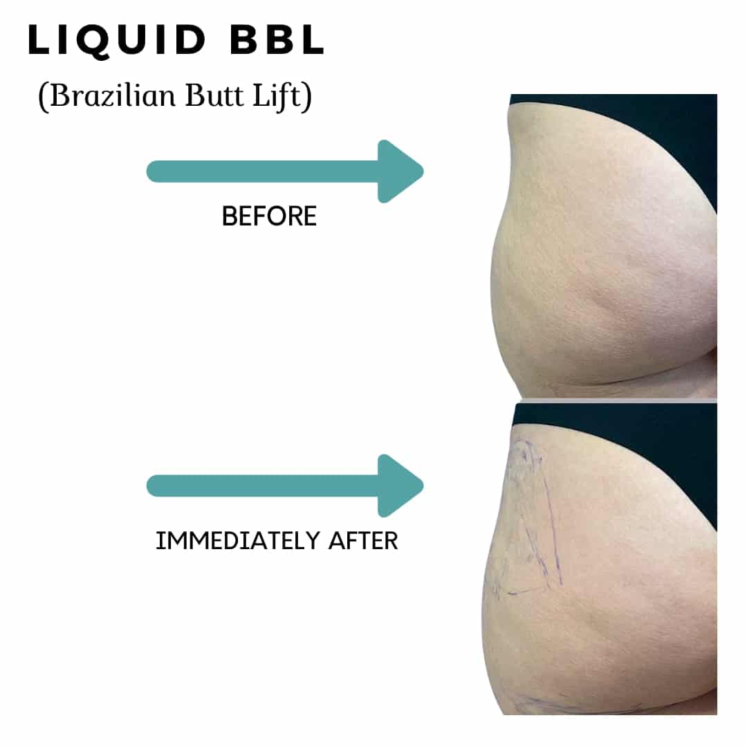 Liquid BBL Real Patient Results by Dr. Vinod Chopra in Washington, D.C. and Fairfax, VA