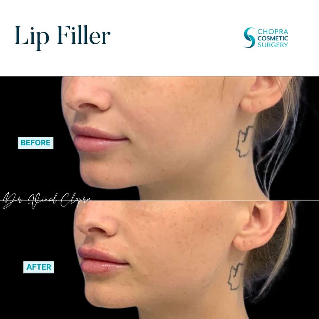 Lip Filler Real Patient Results by Dr. Vinod Chopra in Washington, D.C. and Fairfax, VA