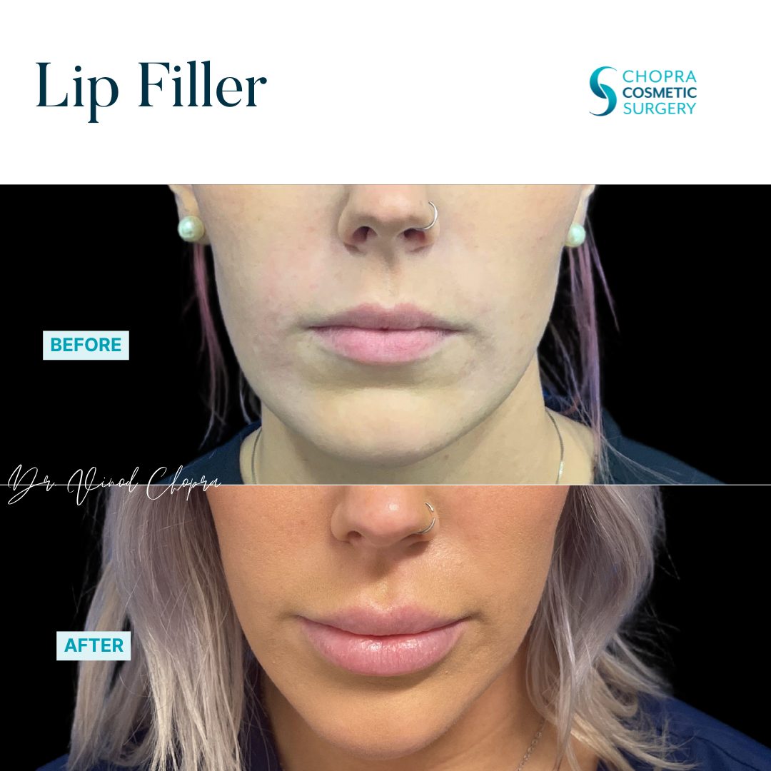 Lip Filler Real Patient Results by Dr. Vinod Chopra in Washington, D.C. and Fairfax, VA
