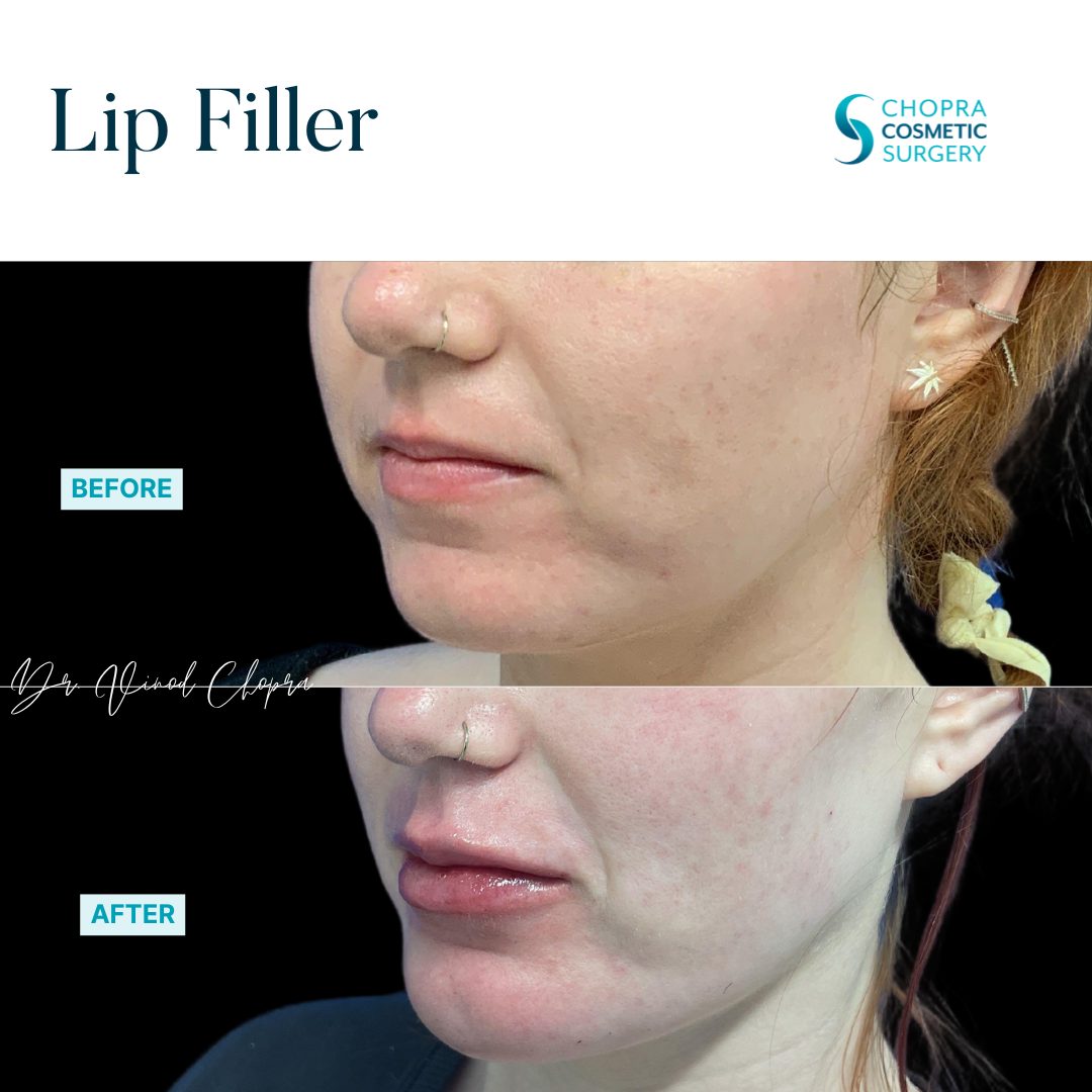 Lip Filler Real Patient Results by Dr. Vinod Chopra in Washington, D.C. and Fairfax, VA