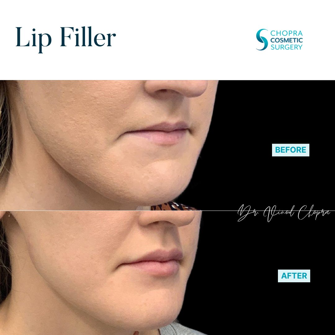 Lip Filler Real Patient Results by Dr. Vinod Chopra in Washington, D.C. and Fairfax, VA