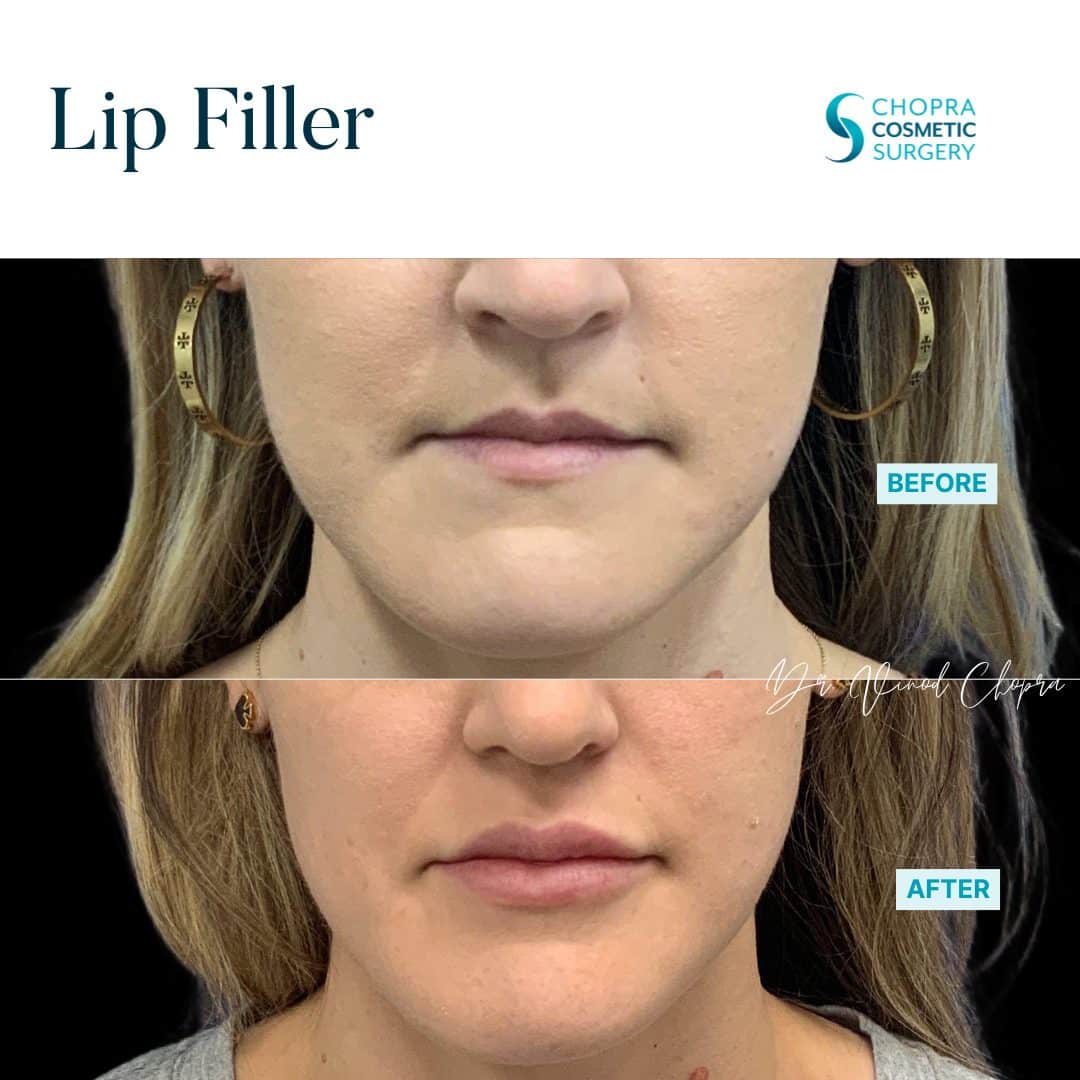 Lip Filler Real Patient Results by Dr. Vinod Chopra in Washington, D.C. and Fairfax, VA