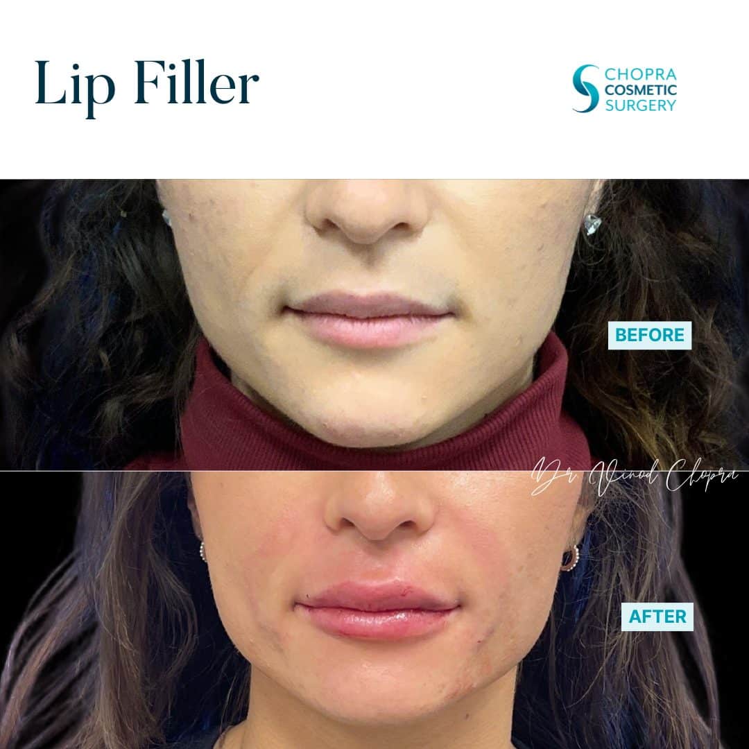 Lip Filler Real Patient Results by Dr. Vinod Chopra in Washington, D.C. and Fairfax, VA
