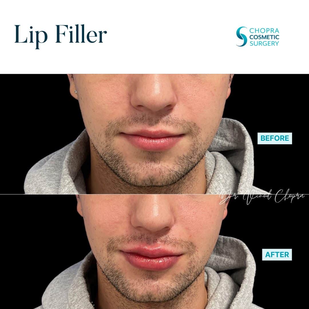 Lip Filler Real Patient Results by Dr. Vinod Chopra in Washington, D.C. and Fairfax, VA