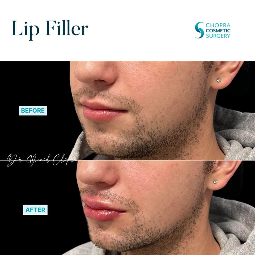 Lip Filler Real Patient Results by Dr. Vinod Chopra in Washington, D.C. and Fairfax, VA