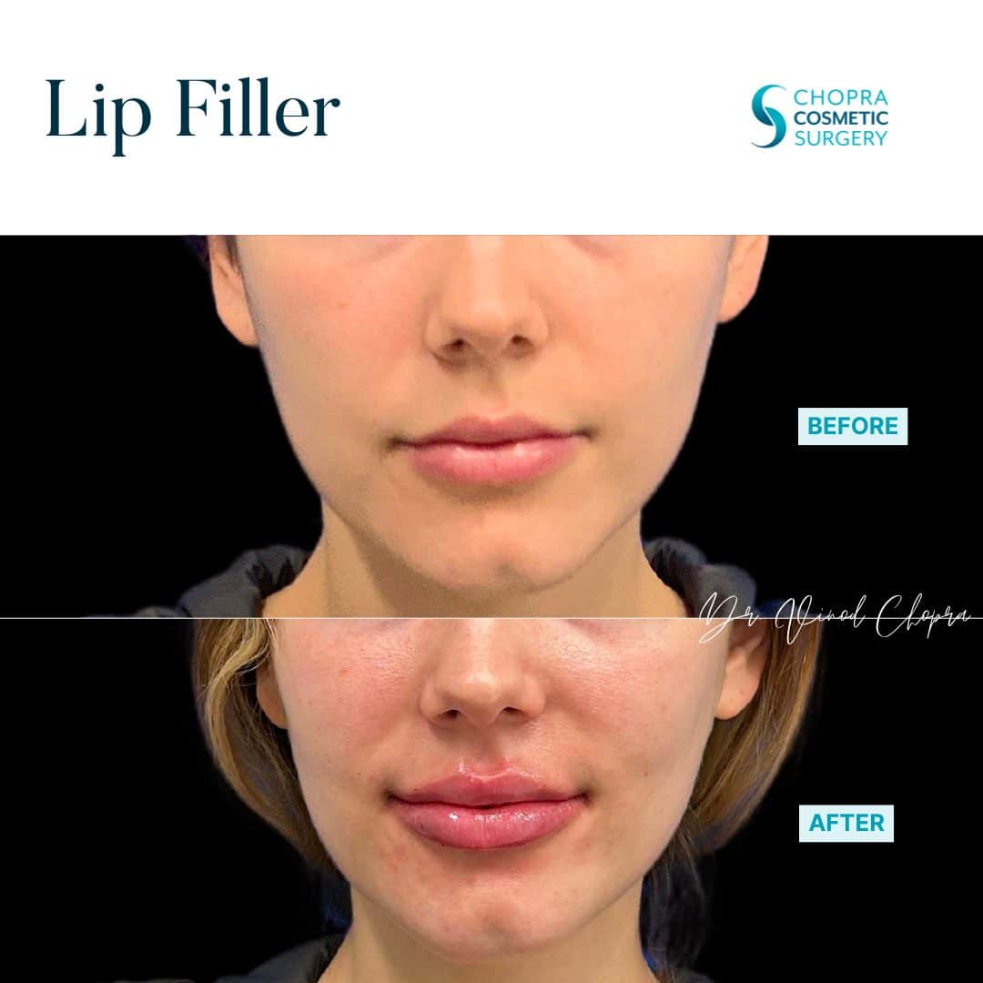 Lip Filler Real Patient Results by Dr. Vinod Chopra in Washington, D.C. and Fairfax, VA