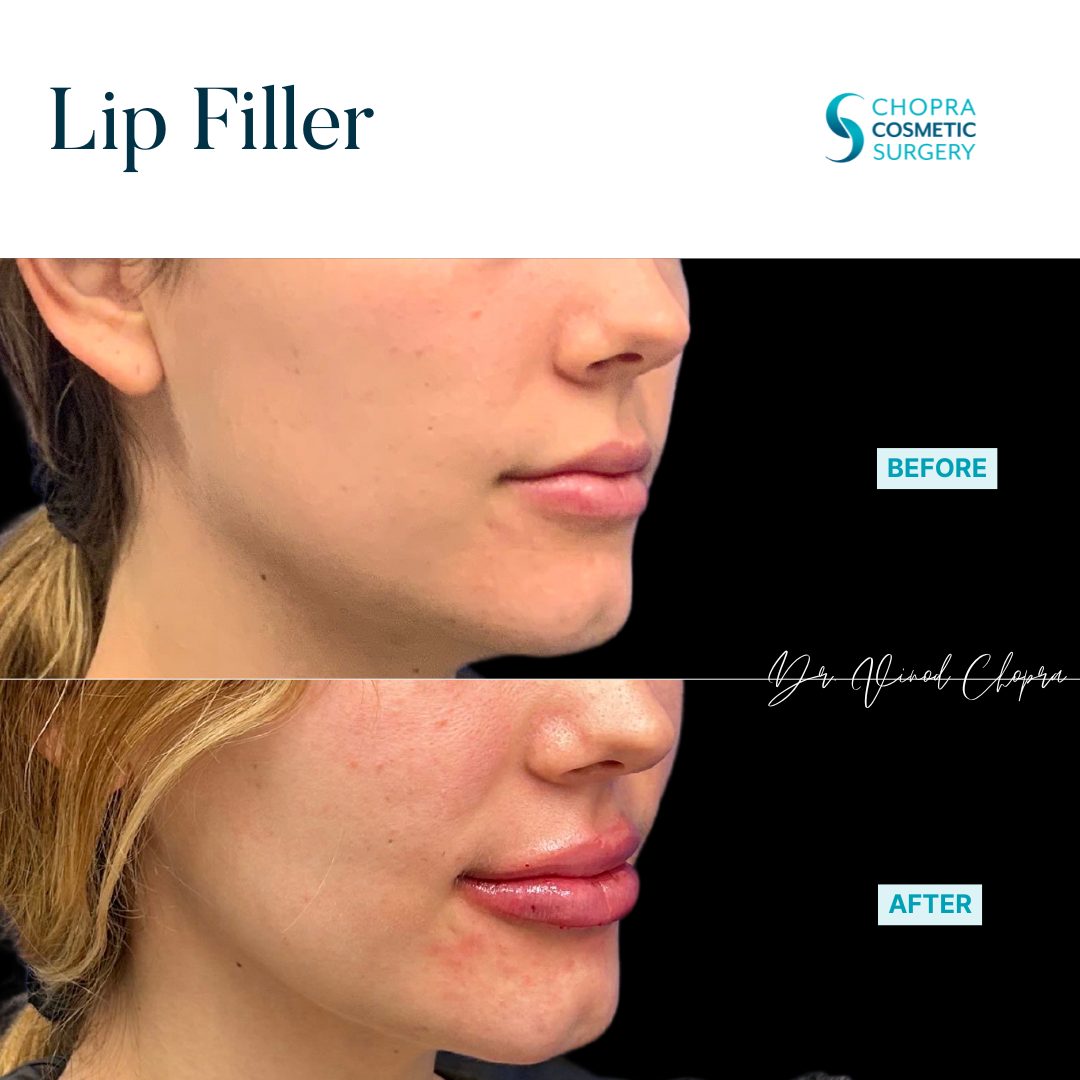 Lip Filler Real Patient Results by Dr. Vinod Chopra in Washington, D.C. and Fairfax, VA