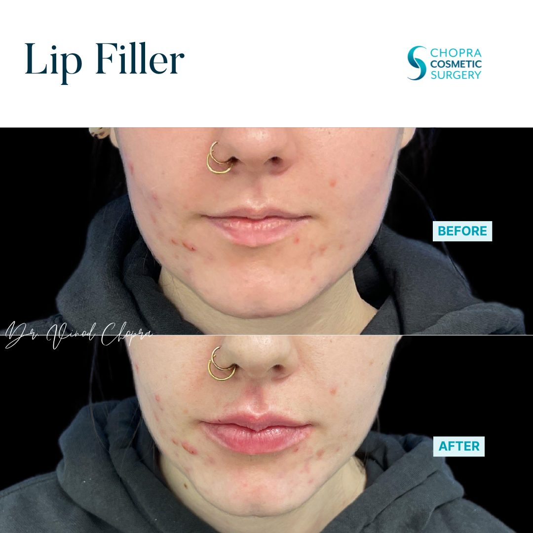 Lip Filler Real Patient Results by Dr. Vinod Chopra in Washington, D.C. and Fairfax, VA