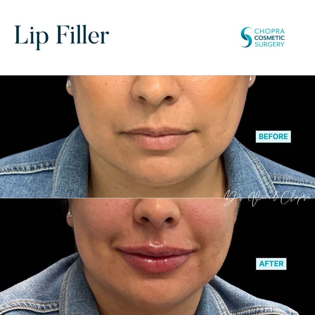 Lip Filler Real Patient Results by Dr. Vinod Chopra in Washington, D.C. and Fairfax, VA