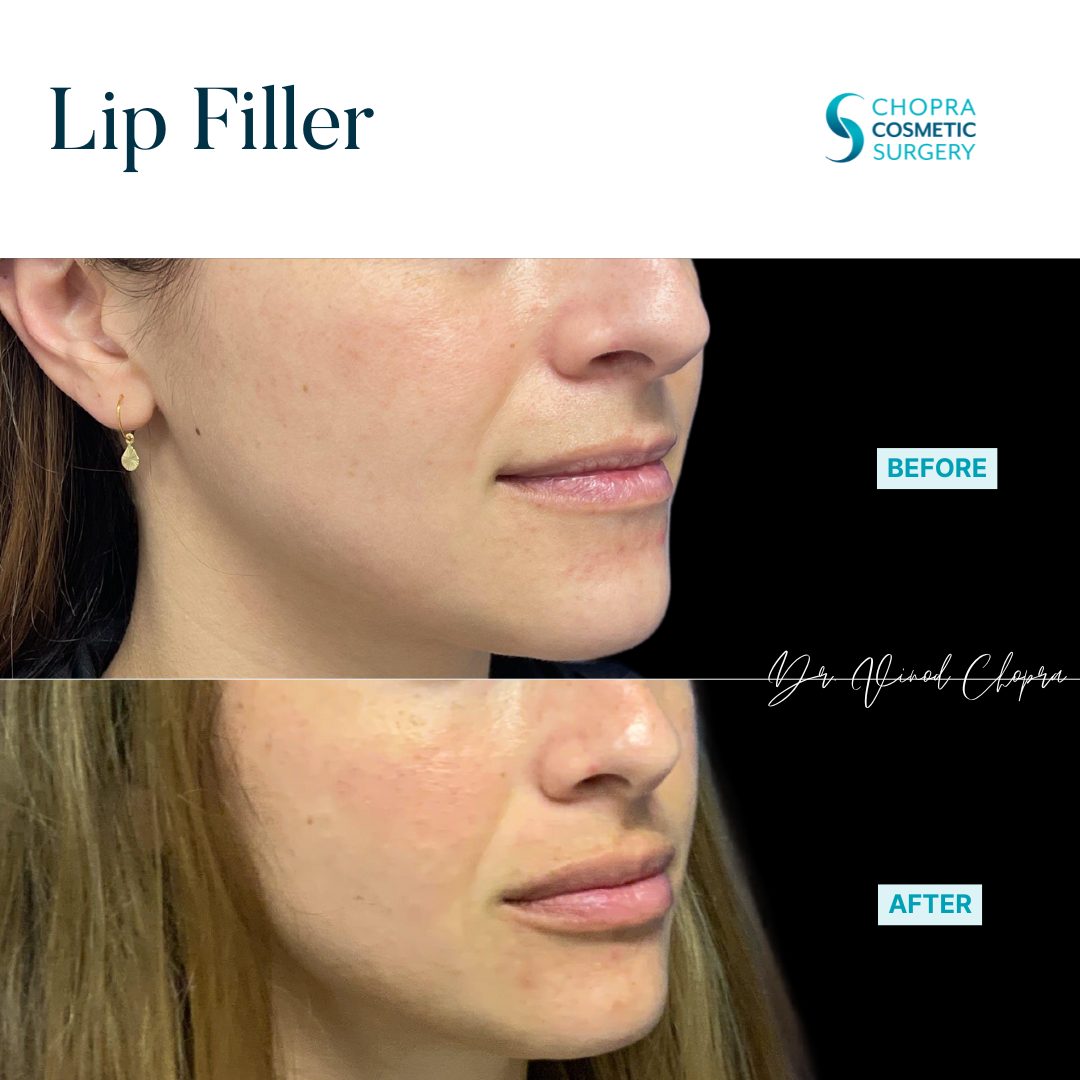Lip Filler Real Patient Results by Dr. Vinod Chopra in Washington, D.C. and Fairfax, VA