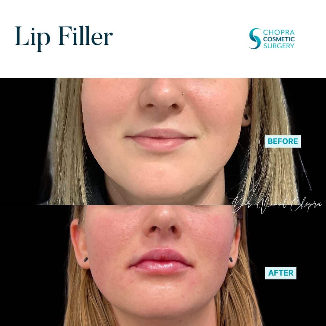 Lip Filler Real Patient Results by Dr. Vinod Chopra in Washington, D.C. and Fairfax, VA