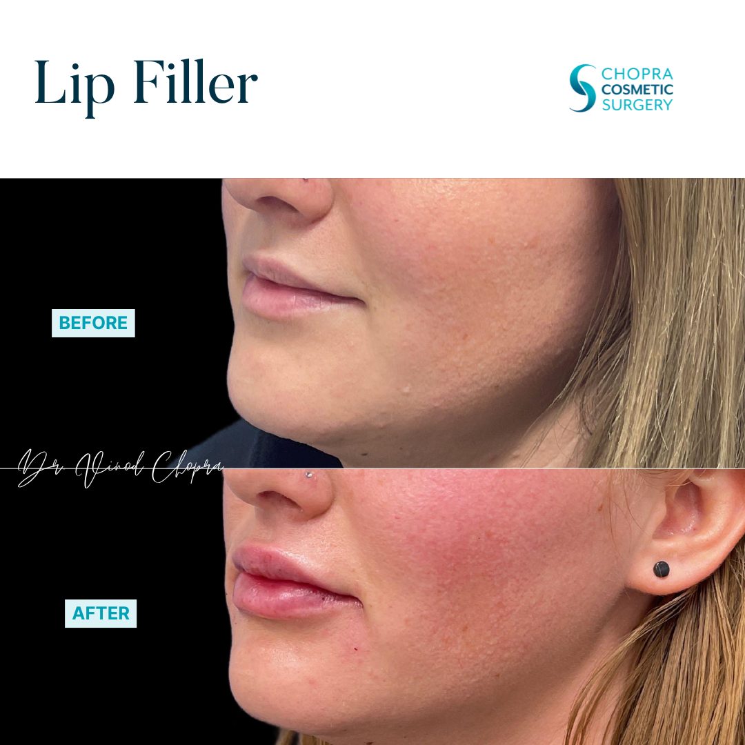 Lip Filler Real Patient Results by Dr. Vinod Chopra in Washington, D.C. and Fairfax, VA