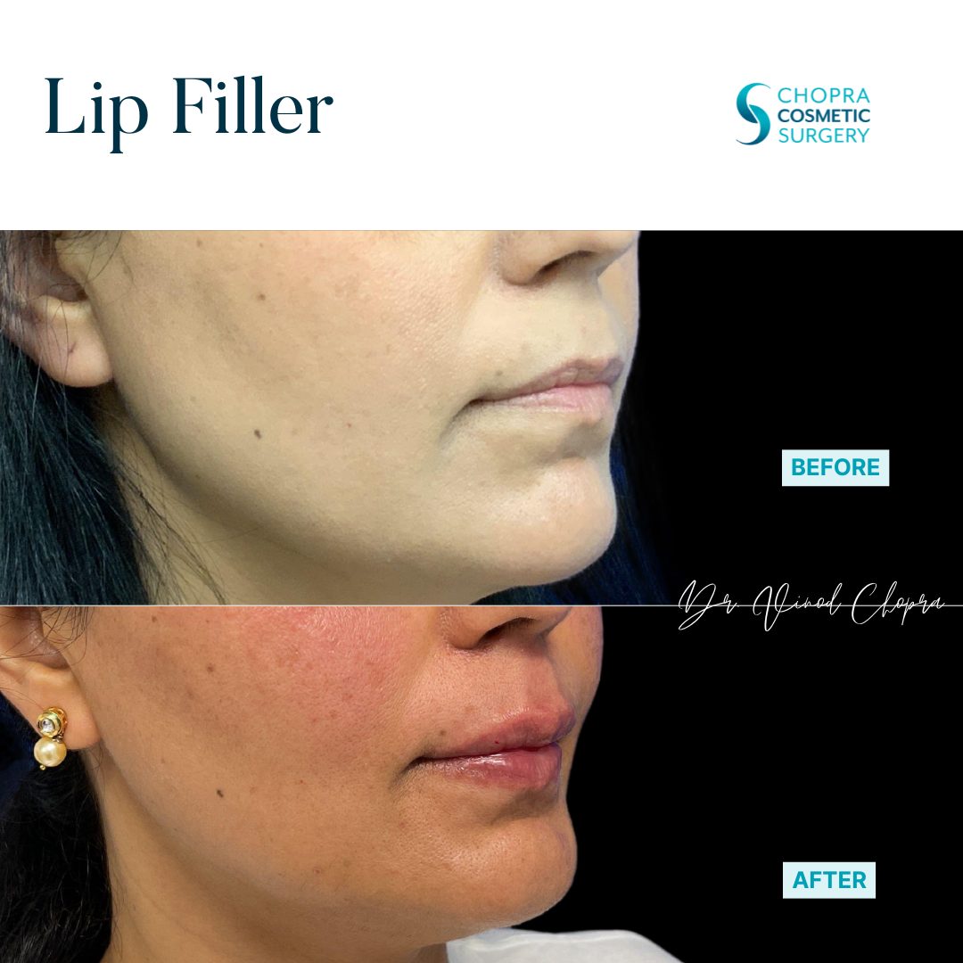 Lip Filler Real Patient Results by Dr. Vinod Chopra in Washington, D.C. and Fairfax, VA