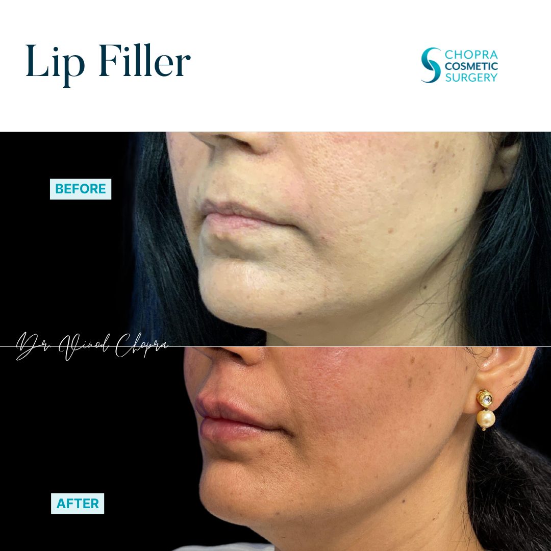 Lip Filler Real Patient Results by Dr. Vinod Chopra in Washington, D.C. and Fairfax, VA