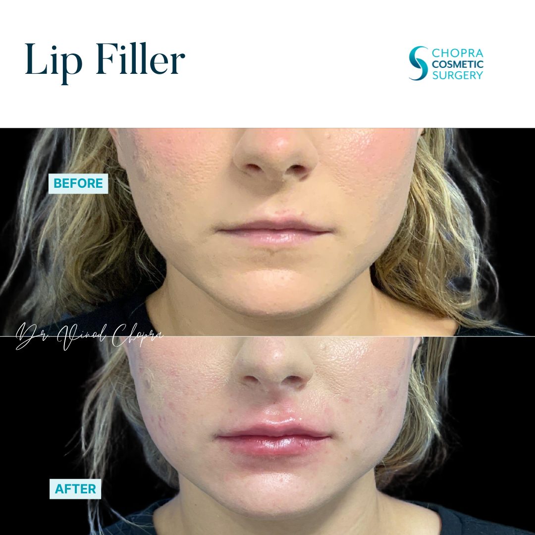 Lip Filler Real Patient Results by Dr. Vinod Chopra in Washington, D.C. and Fairfax, VA
