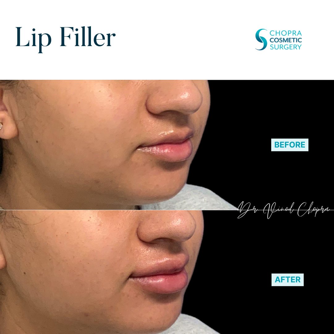 Lip Filler Real Patient Results by Dr. Vinod Chopra in Washington, D.C. and Fairfax, VA