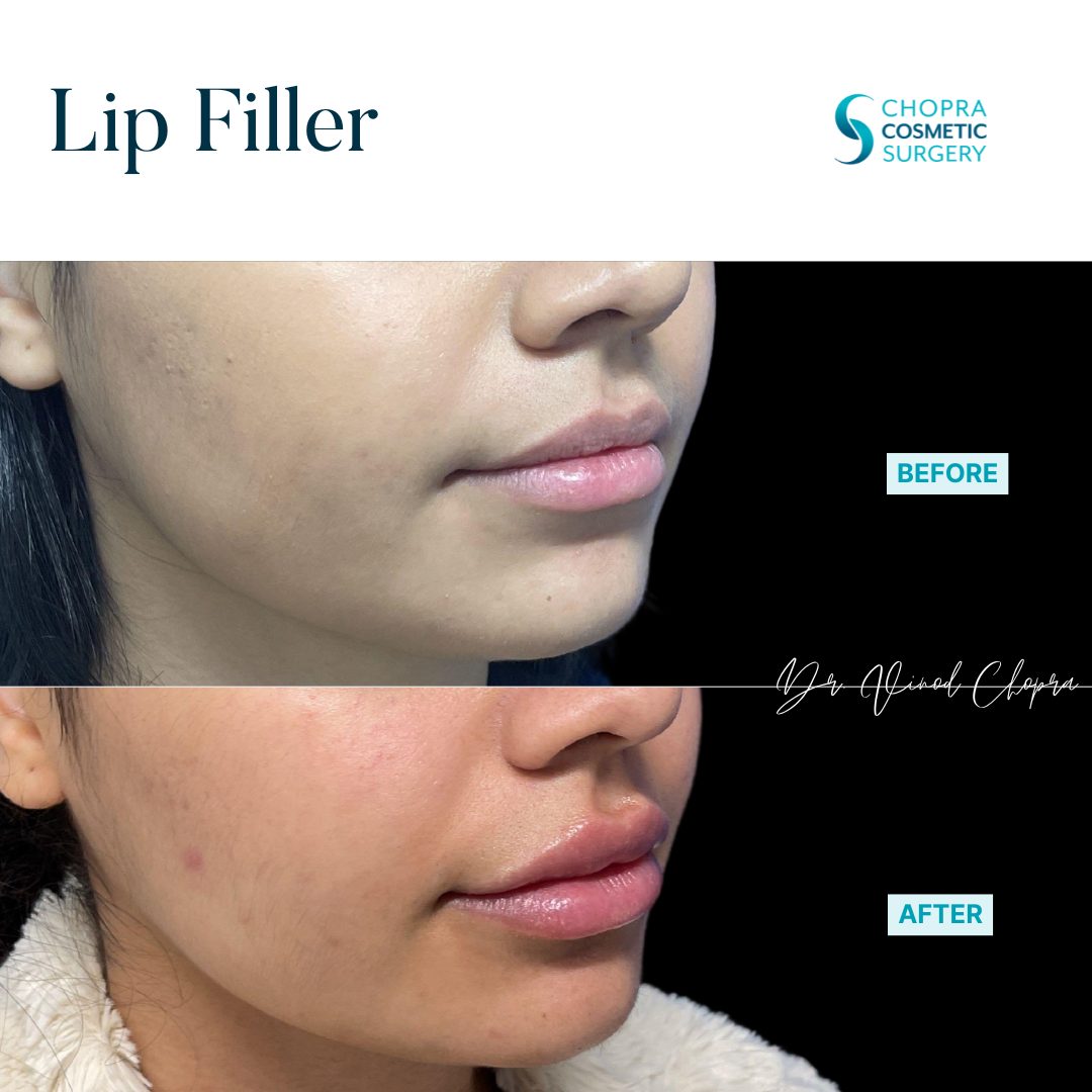 Lip Filler Real Patient Results by Dr. Vinod Chopra in Washington, D.C. and Fairfax, VA