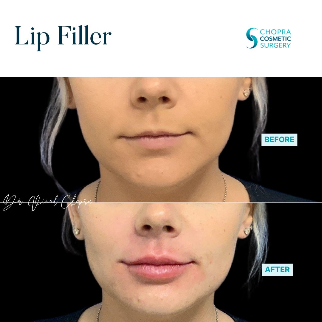 Lip Filler Real Patient Results by Dr. Vinod Chopra in Washington, D.C. and Fairfax, VA